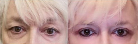 Klientky díky korekci očních víček omládnou o 10 let a ještě lépe vidí